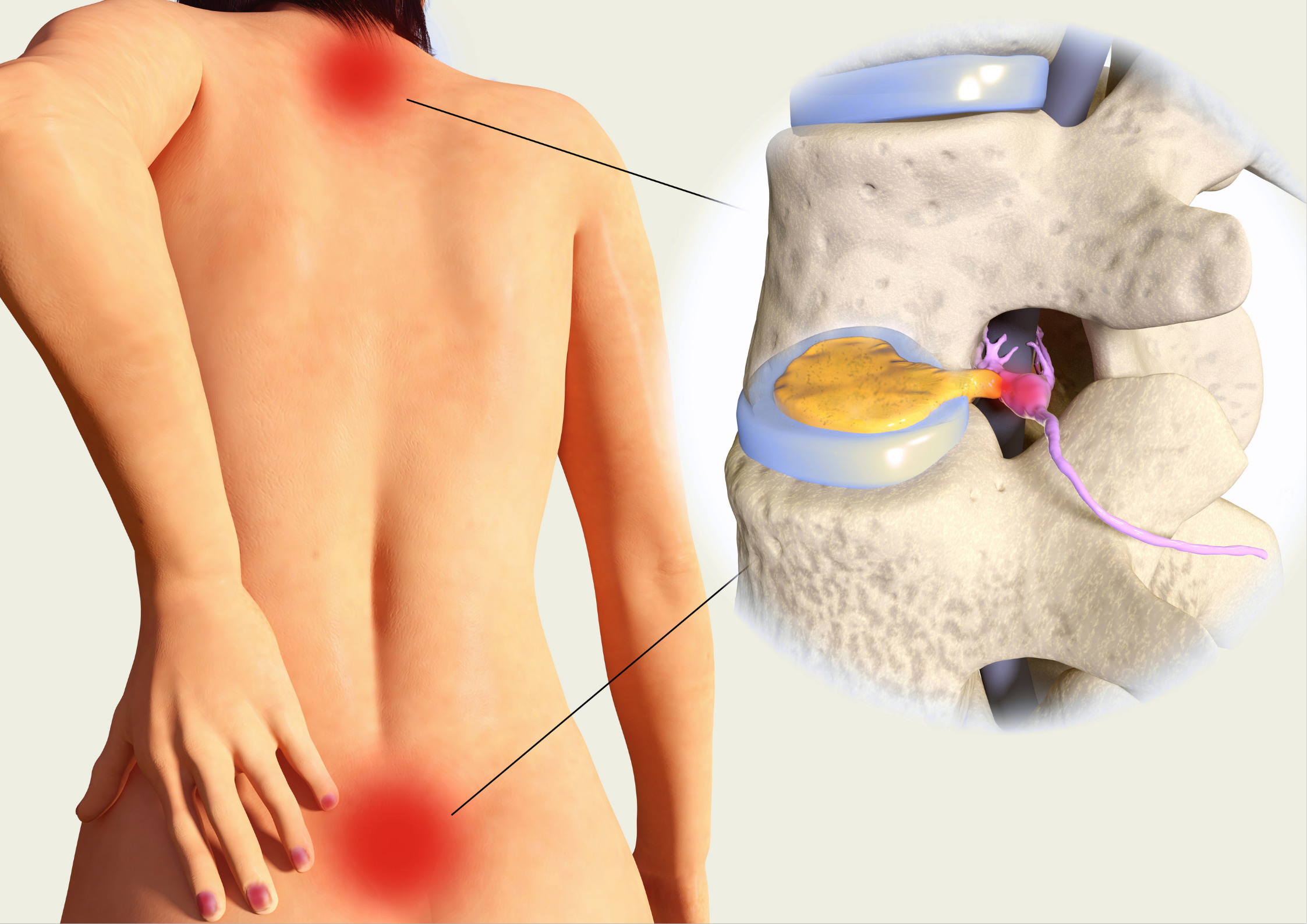 3D medical illustration showing a woman's back with red pain indicators at the thoracic and lumbar spine regions alongside a magnified anatomical cross-section of a bulging or herniated spinal disc compressing a spinal nerve root.