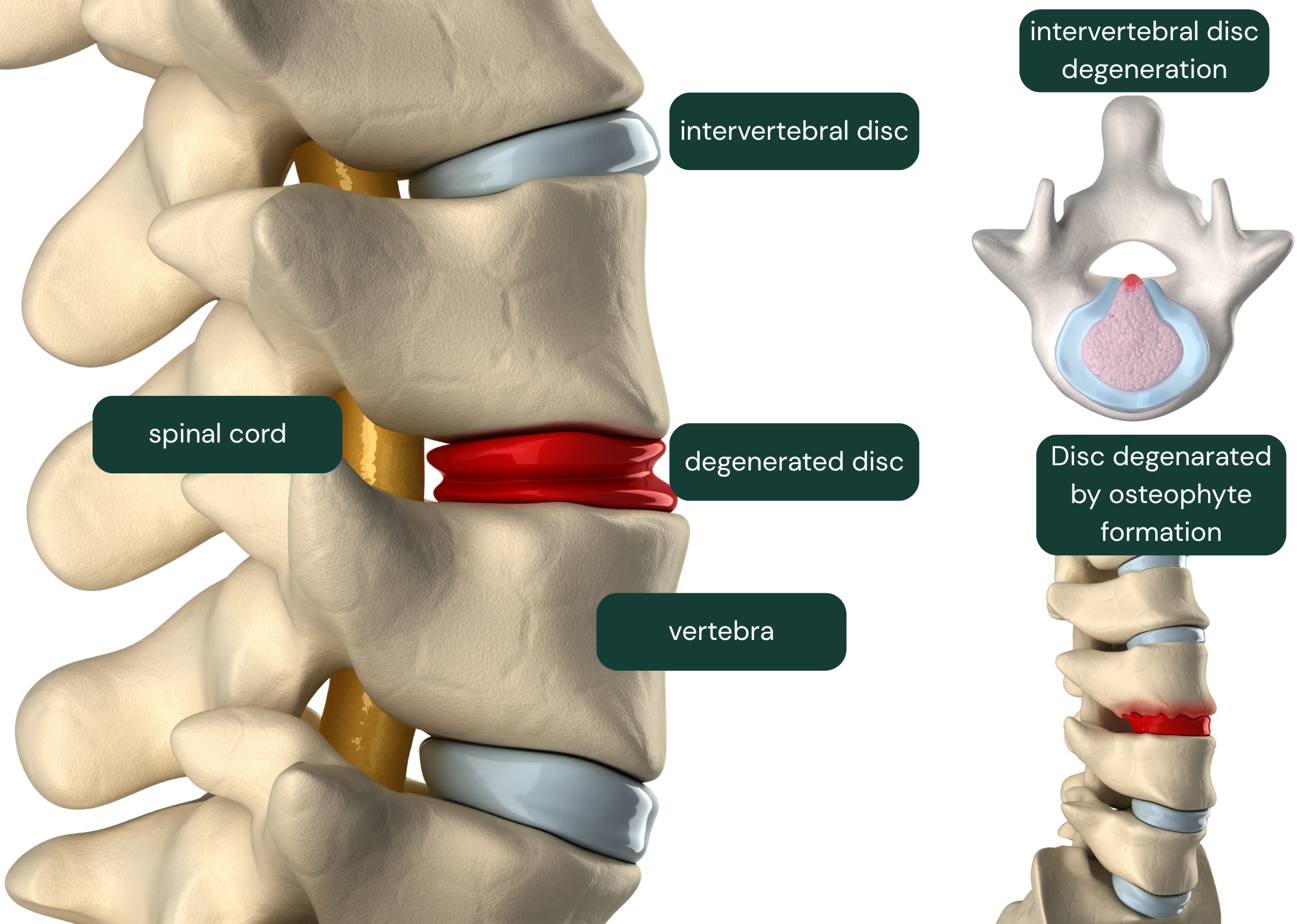 3D anatomical illustration of the lumbar spine showing a labelled intervertebral disc, degenerated disc in red, spinal cord, and vertebra alongside two inset diagrams of intervertebral disc degeneration and disc degenerated by osteophyte formation.
